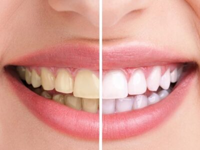 Formare pentru albirea cosmetică a dinților