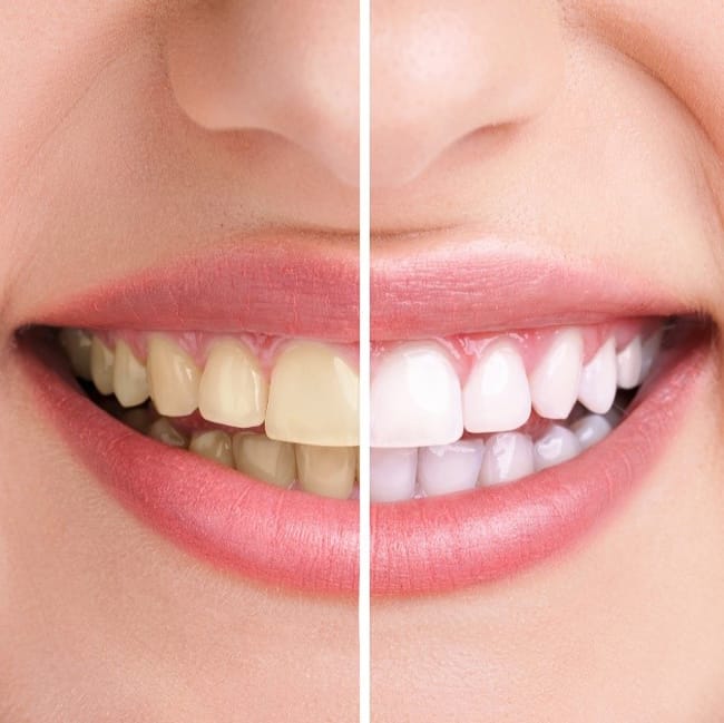 bleaching-vorher-nachher bleaching-vorher-nachher